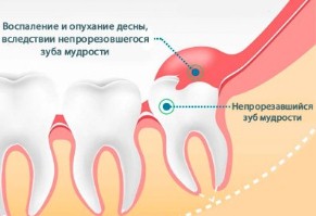 Лечение перикоронита (иссечение капюшона зуба мудрости)