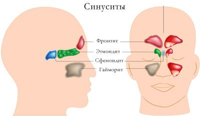 Острый синусит: описание, симптомы, диагностика и лечение | ЛабСтори